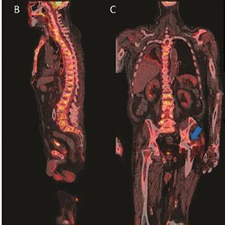 Fluorine-18-FDG PET/CT scan (A) MIP, (B) sagittal fusion, (C) coronal... | Download Scientific ...