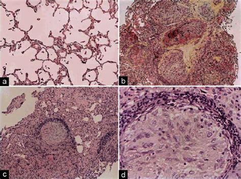 (a-d) Histopathology of the hilar lymph nodes on transbronchial biopsy.... | Download Scientific ...