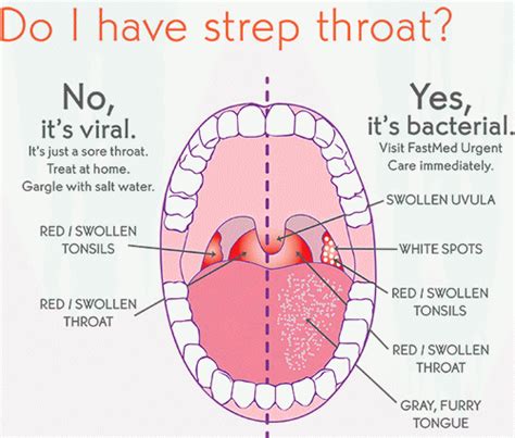 Strep Throat Symptoms - The Best Antibiotics For Strep Throat