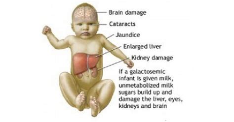 Maple Syrup Urine Disease - New