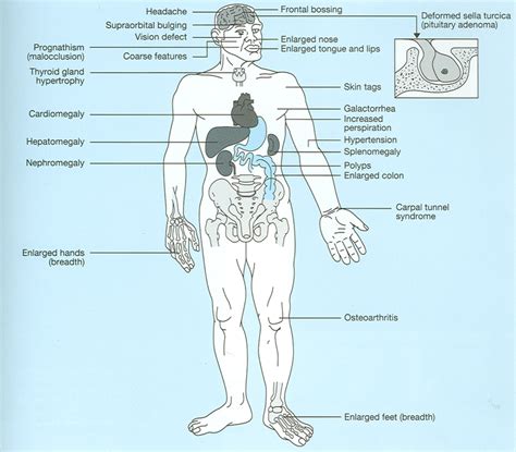 Symptoms - Pituitary Dwarfism & Gigantism