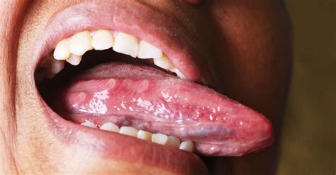 What Your Tongue And Tonsils Could Tell You About Your Sleeping Habits ...