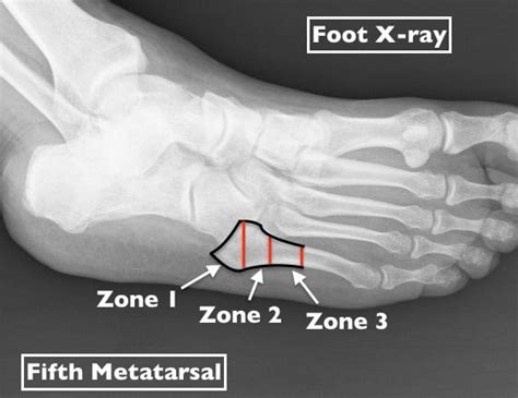 What Exactly is a Jones Fracture (Foot) and Why Might it Need Surgery?