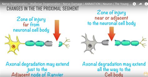 Wallerian Degeneration and Nerve Regeneration — OrthopaedicPrinciples.com