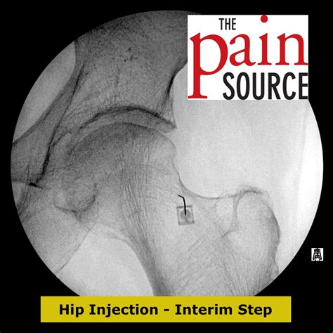 Hip Joint Injection With Fluoroscopy - Technique and Tips ...