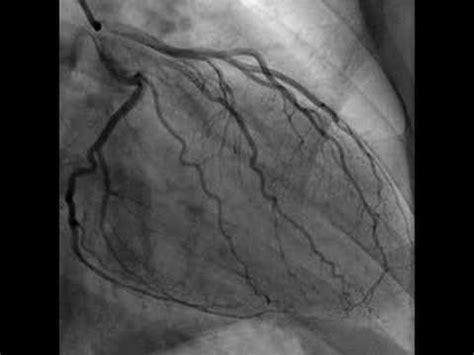 Cardiac Catheterization (Heart video) - YouTube