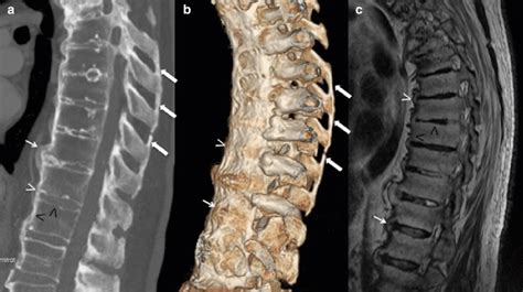 2 Crohn's disease related to ankylosing spondylitis. Sagittal ...