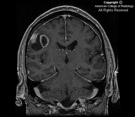 Neuroradiology On the Net: Gliosarcoma