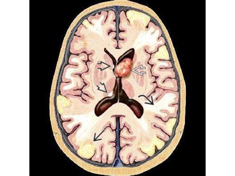 Tuberous sclerosis