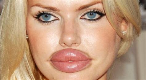 Terrifying Lip Filler Fails | ThatViralFeed