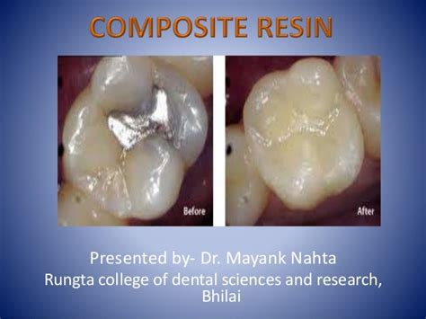 Composite resin restoration in dentistry