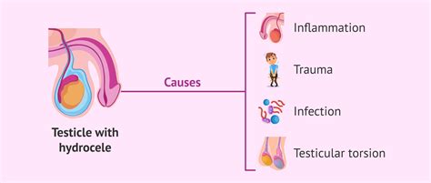 Causes of testicular hydrocele