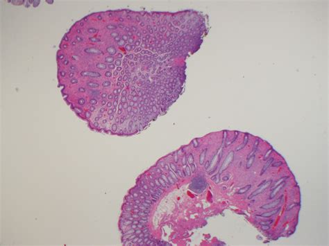 Pathology Outlines - Ganglioneuroma