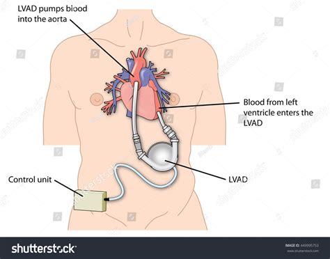 60 Ventricular assist device Images, Stock Photos & Vectors | Shutterstock