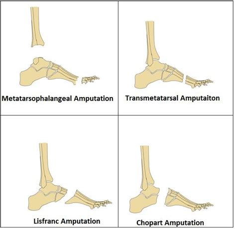 Amputation Of Lower Limb: Indication, Type, Treatment