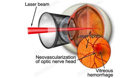 Argon laser for diabetic retinopathy | Stock eye images