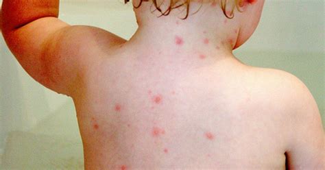 11-Month-Old Suffers Stroke After Contracting Chicken Pox From ...