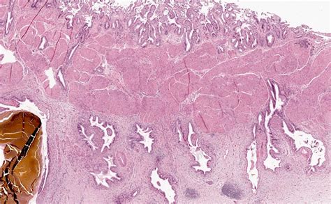 Pathology Outlines - Chronic cholecystitis