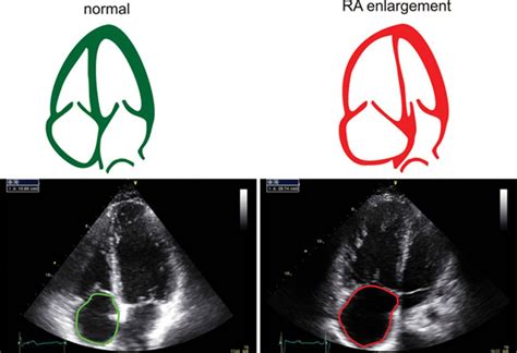 Reference Values for and Determinants of Right Atrial Area in Healthy ...