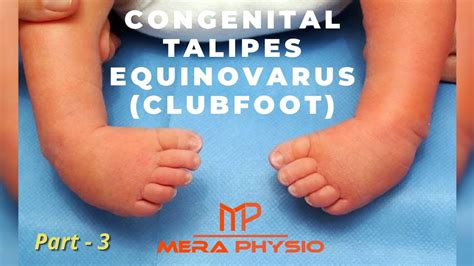 Congenital Talipes Equinovarus (Clubfoot) - pt 3 | Physiotherapy Treatment | In Hindi | Mera ...