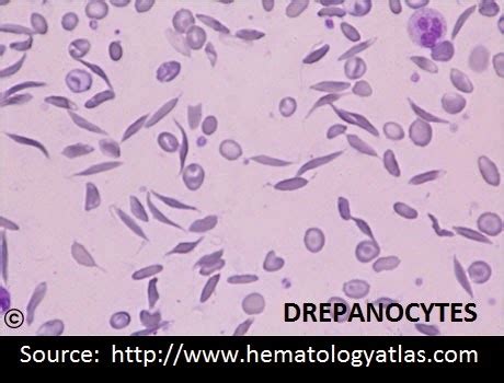 Lab Atlas: Drepanocytes