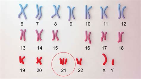 About Down Syndrome