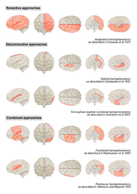 Illustration methods hemispherectomy - MedicalGraphics