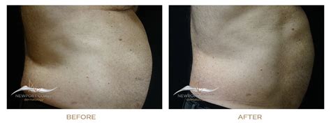 Before & After Vanquish – Newport Coast Dermatology