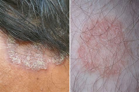 Psoriasis vs. Ringworm: Key Similarities and Differences