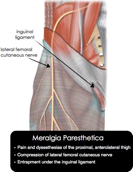 Meralgia paresthetica: pain or dysesthesias, or both in the anterolateral, proximal thigh, due ...