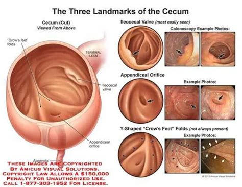 Pictures Of Cecum