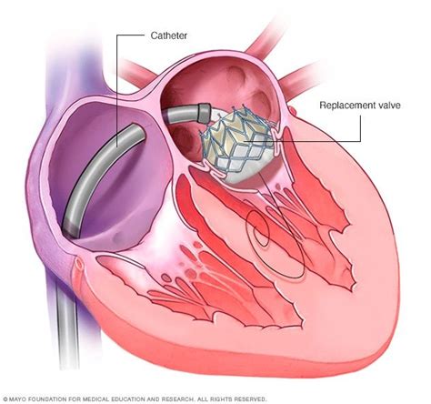 Mitral Valve Replacement Cpt Code