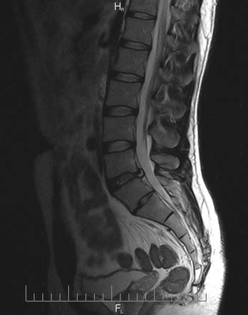 Lumbosacral transitional vertebra | Radiology Case | Radiopaedia.org