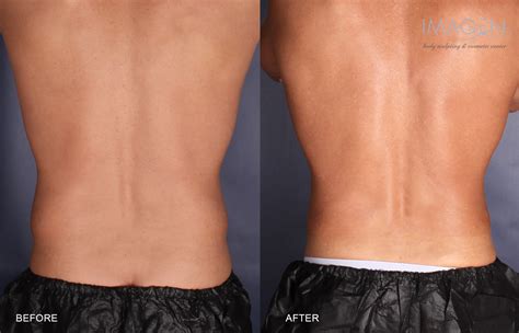 CoolSculpting Omaha - Omaha Liposuction by Imagen