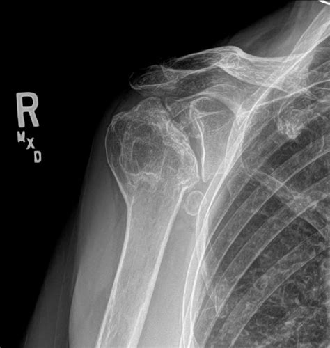 Glenohumeral Arthritis (Shoulder Arthritis) - Shoulder & Elbow - Orthobullets