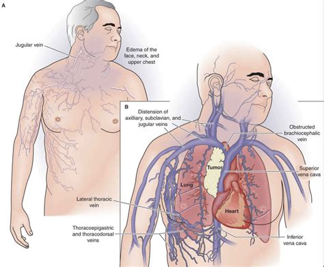 Superior vena cava anatomy, function & superior vena cava syndrome