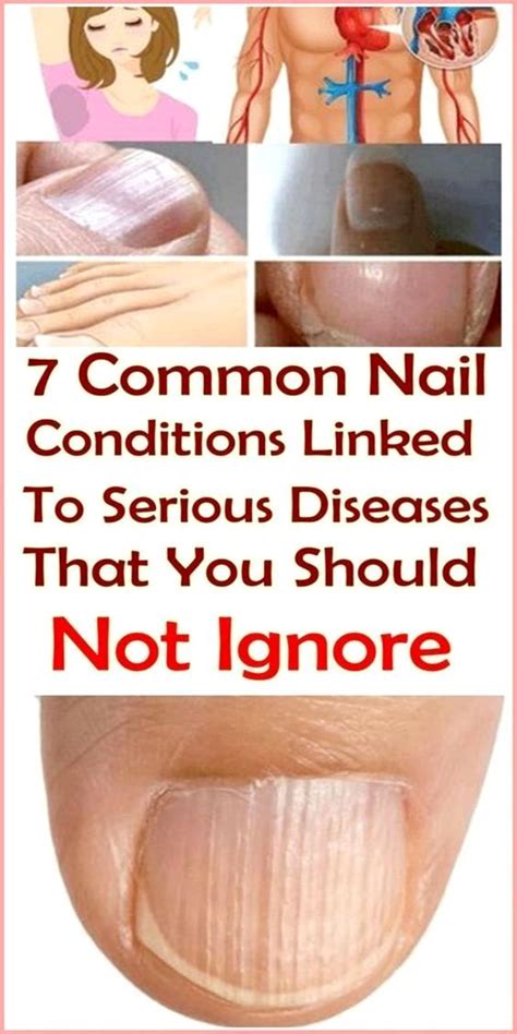 Pin by Syed Irshad Ali on Health in 2020 | Nail conditions, Blue nail beds, White nail beds