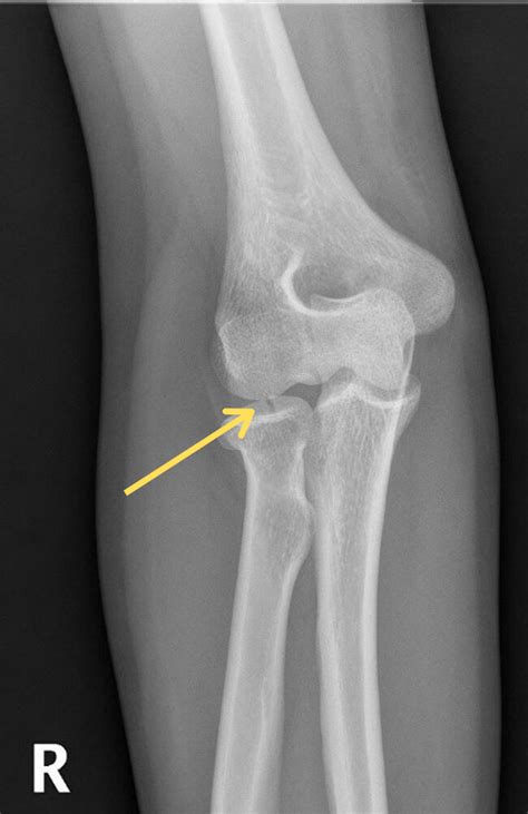 Radial head and neck fractures - Don't Forget the Bubbles