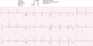 Reciprocal Changes and Occlusion MI | ECG Cases | Emergency Medicine Cases