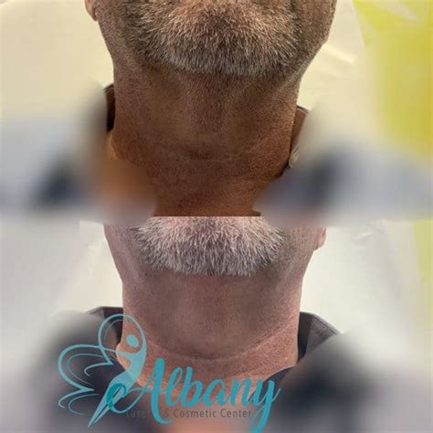 Laser Neck Tightening: Case No.1067 Albany Cosmetic and Laser Centre In Edmonton