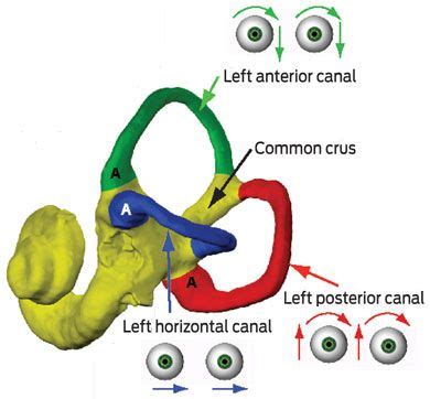 Anterior Bppv Epley Maneuver | The left inner ear, showing nystagmus profiles of benign ...