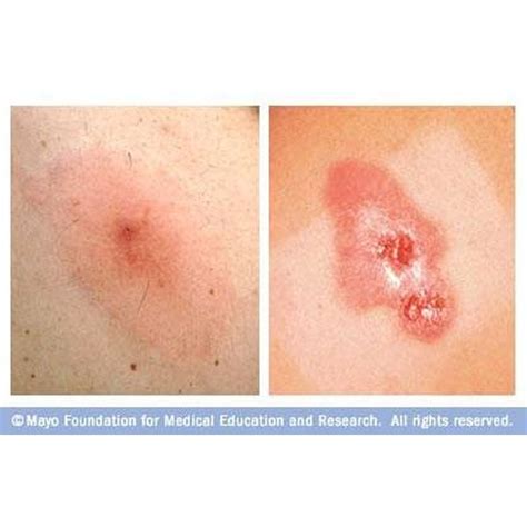 Symptoms of an MRSA Staph Infection | Healthfully