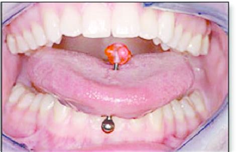 Dorsoventral placement of a tongue piercing. | Download Scientific Diagram