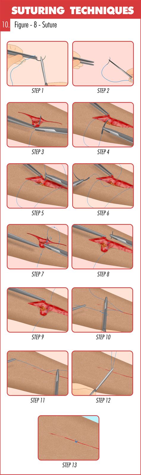 Surgical Suturing Techniques Mastery Guide - Apprentice Doctor