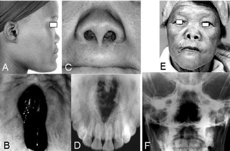 Saddle Nose Deformity Syphilis