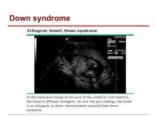 Echogenic fetal bowel | PPT