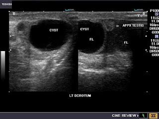 cochinblogs: Ultrasound- Spermatoceles versus epididymal cysts: