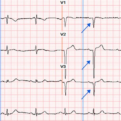 -12 lead ECG demonstrating prominent Q-waves in V1-V3. | Download ...