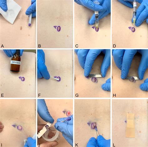 Shave biopsy technique and hemostasis pearl : Journal of the American Association of Nurse ...