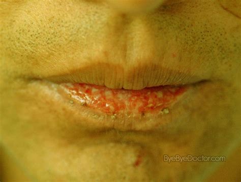 actinic cheilitis pictures - pictures, photos